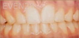 Kristy-Vetter-Orthodontic-Braces-after-1