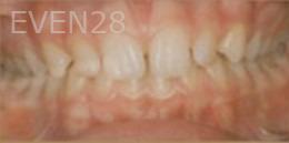 Kristy-Vetter-Orthodontic-Braces-before-1