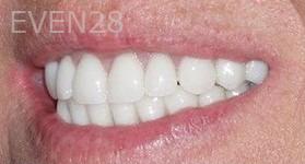 Maryam-Horiyat-All-on-Four-Dental-Implants-after-4