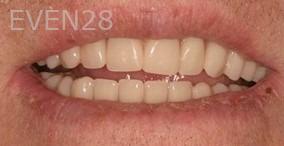 Maryam-Horiyat-All-on-Four-Dental-Implants-after-5
