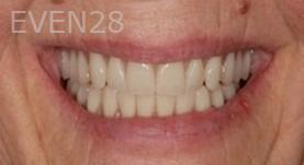 Maryam-Horiyat-All-on-Four-Dental-Implants-after-6