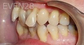 Maryam-Horiyat-All-on-Four-Dental-Implants-before-4