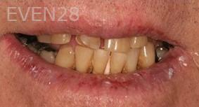 Maryam-Horiyat-All-on-Four-Dental-Implants-before-5