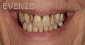Maryam-Horiyat-All-on-Four-Dental-Implants-before-6