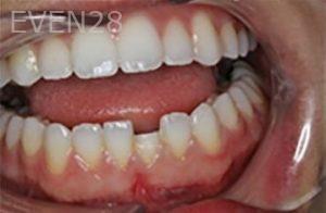 Maryam-Horiyat-Dental-Bonding-before-1