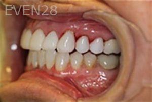 Maryam-Horiyat-Dental-Crowns-after-1