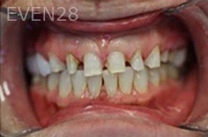 Maryam-Horiyat-Dental-Crowns-before-1