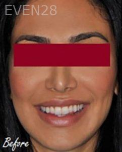 Maryam-Horiyat-Teeth-Whitening-before-2