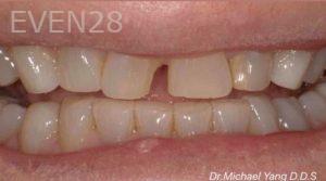 Michael-Yang-Dental-Bonding-before-2