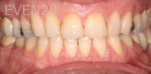 Mona-Goodarzi-Dental-Bonding-before-1