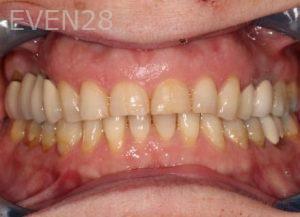 Mona-Goodarzi-Dental-Bonding-before-2