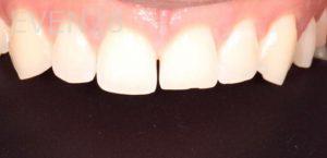 Mona-Goodarzi-Dental-Bonding-before-3