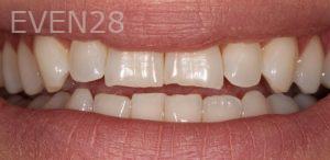 Mona-Goodarzi-Dental-Crown-before-1