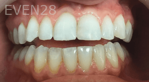 Olliver-Cruz-Dental-Bonding-after-1
