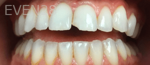 Olliver-Cruz-Dental-Bonding-before-1