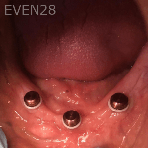 Olliver-Cruz-Implant-Supported-Overdentures-before-1