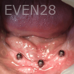 Olliver-Cruz-Implant-Supported-Overdentures-before-1b