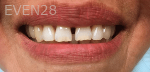 Olliver-Cruz-Dental-Bonding-before-1