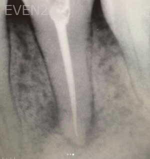 Olliver-Cruz-Root-Canal-Therapy-after-1b
