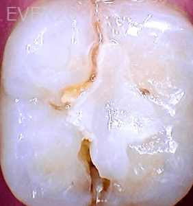 Olliver-Cruz-Tooth-Extraction-Bone-Graft-before-1