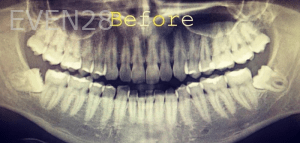 Olliver-Cruz-Wisdom-Tooth-Extraction-before-1