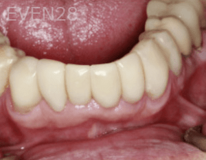 Randy-Fing-Bioclear-Teeth-Rejuvenation-after-2