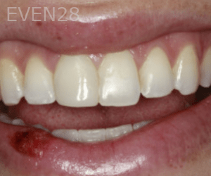 Randy-Fing-Bioclear-Teeth-Rejuvenation-after-3