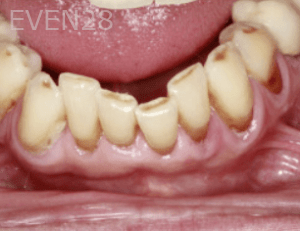 Randy-Fing-Bioclear-Teeth-Rejuvenation-before-2