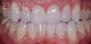 Richard-Hada-ClearCorrect-Clear-Aligners-after-1