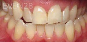Richard-Hada-ClearCorrect-Clear-Aligners-before-1