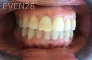 Rozita-Nosratabadi-Internal-Tooth-Bleaching-after-1