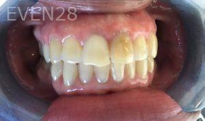 Rozita-Nosratabadi-Internal-Tooth-Bleaching-before-1