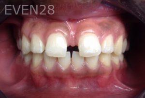 Rozita-Nosratabadi-Invisalign-Clear-Aligners-before-1