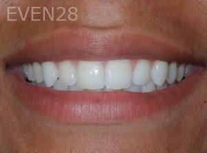 Ryan-Savage-Invisalign-Clear-Aligners-after-1