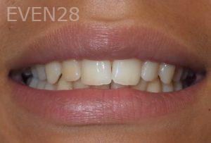 Ryan-Savage-Invisalign-Clear-Aligners-before-1