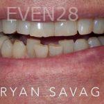 Ryan-Savage-Porcelain-Veneers-before-1