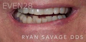 Ryan-Savage-Porcelain-Veneers-before-1