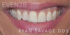 Ryan-Savage-Porcelain-Veneers-before-2