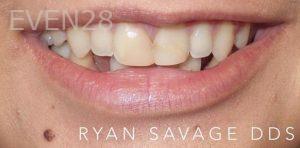Ryan-Savage-Porcelain-Veneers-before-4