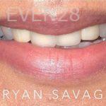 Ryan-Savage-Smile-Makeover-before-1