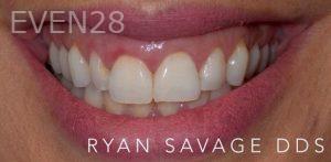 Ryan-Savage-Smile-Makeover-before-2