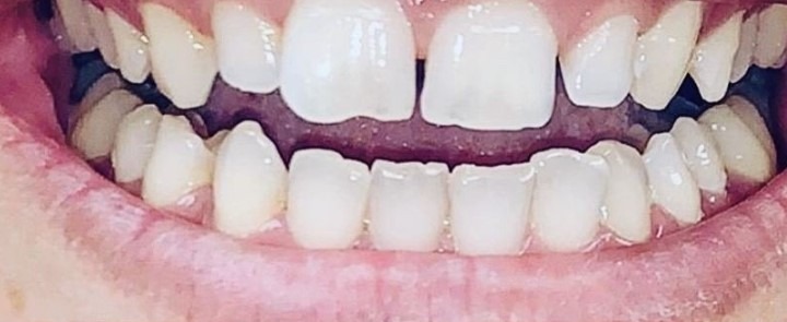 Sahar-Verdi-Gingivectomy-before-1