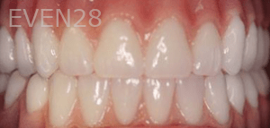 Sean-Mohtashami-All-on-Four-dental-implants-after-2b