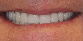 Sean-Mohtashami-All-on-Four-dental-implants-after-2c