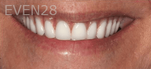 Sean-Mohtashami-All-on-Four-dental-implants-after-4