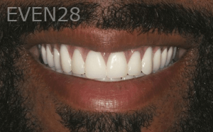 Sean-Mohtashami-All-on-Four-dental-implants-after-5