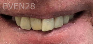 Sean-Mohtashami-All-on-Four-dental-implants-before-2c