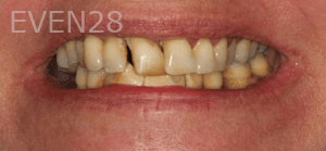 Sean-Mohtashami-All-on-Four-dental-implants-before-4