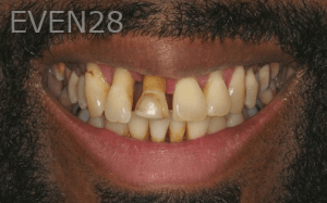 Sean-Mohtashami-All-on-Four-dental-implants-before-5