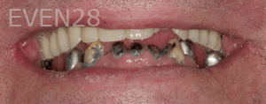 Sean-Mohtashami-All-on-Four-dental-implants-before-9